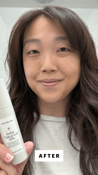 Lee after applying the Naturium Azelaic Topical Acid 10